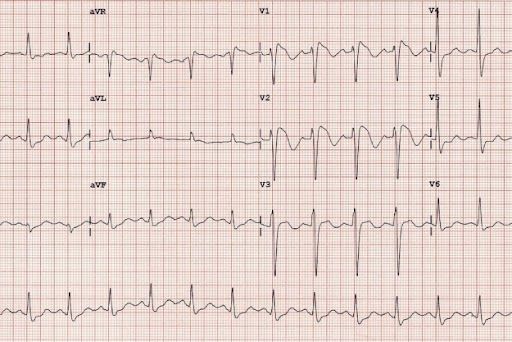Brugada Sendromu EKG Bulguları