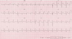 Brugada sendromu nedir?