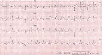 Brugada sendromu nedir?