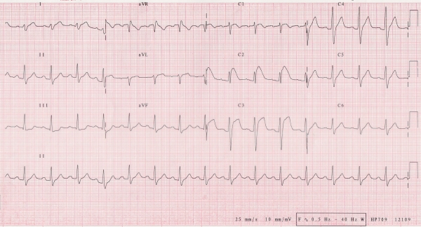 Brugada sendromu nedir?